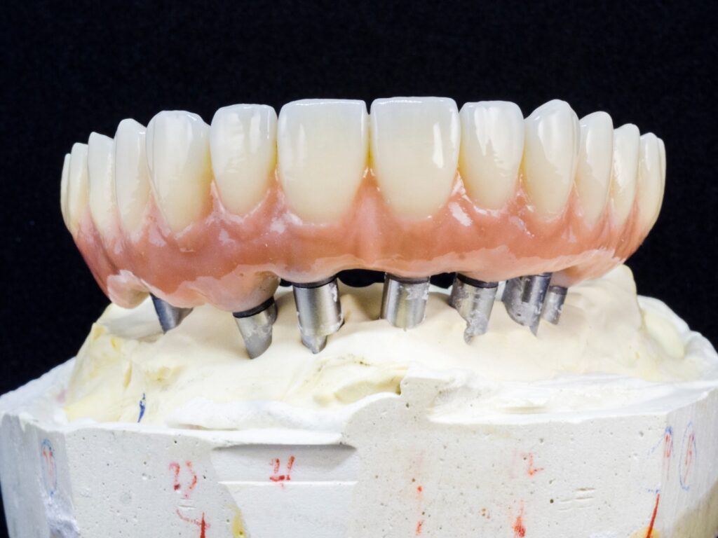 replacement tooth - Northern Westchester Dental Care