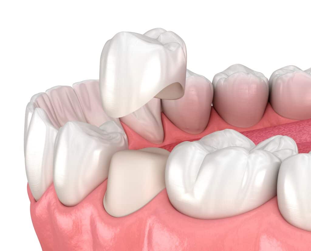 Dental implant surgery is part of prosthodontics.