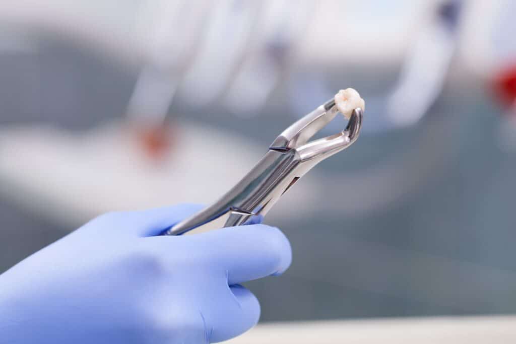 tooth extractions, dental extraction