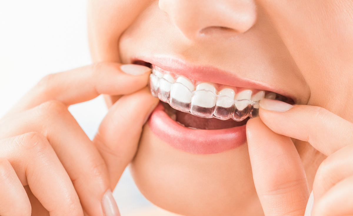 How Long Does Invisalign Take?&nbsp;&nbsp;