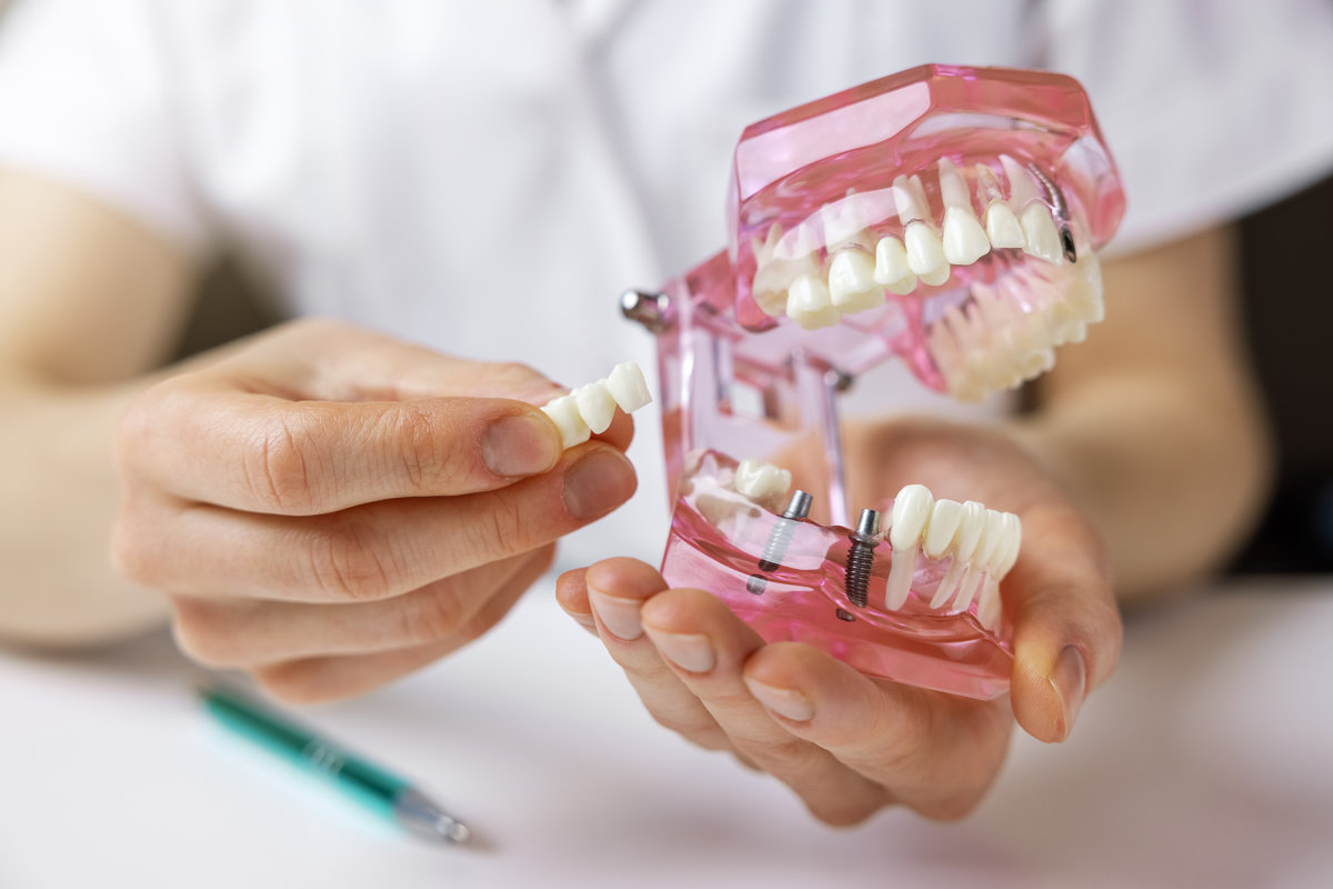 Tooth Replacement Options for Missing Teeth&nbsp;