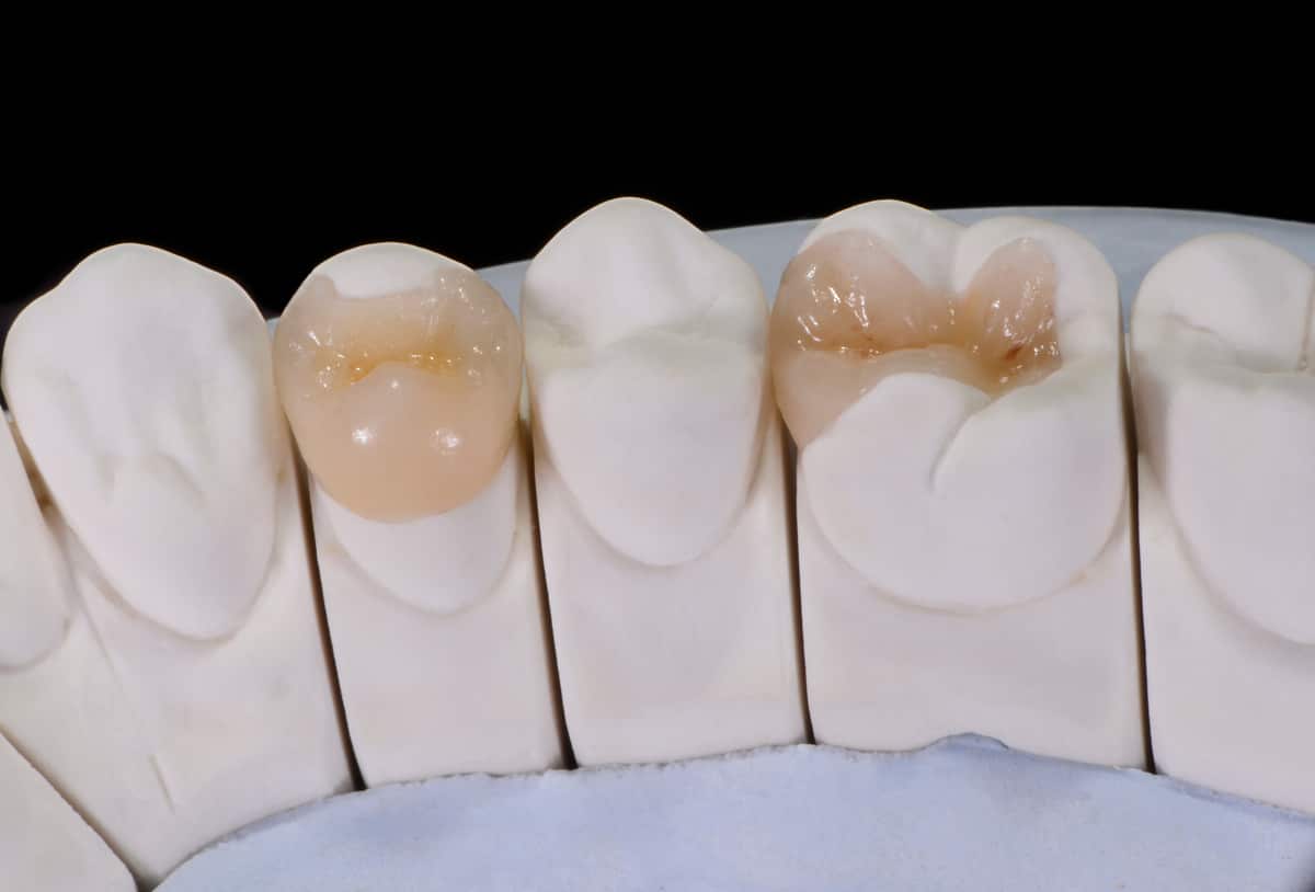 What Are Inlays and Onlays, and When Are They the Right Choice?