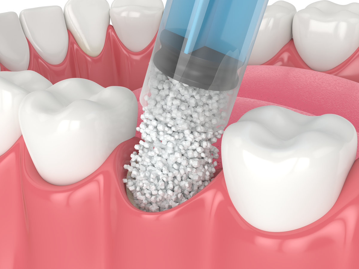 What Is a Dental Bone Graft and When Is It Necessary Before Implants?